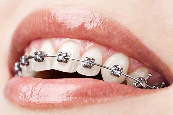 Metal self-ligating braces